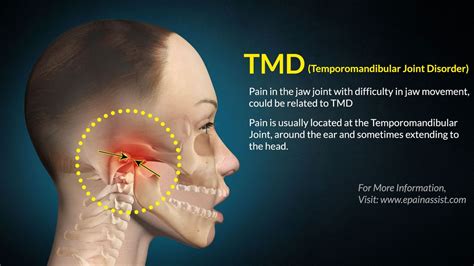 الاضطرابات المفصلية الصدغية (TMJ & TMD): نظرة عامة | 2024