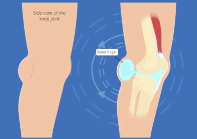 Pain Behind the Knee: Causes and Diagnosis - Sport Doctor London