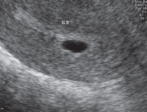 On 3-12-07, showing a single intrauterine gestational sac of 8.4 mm ...