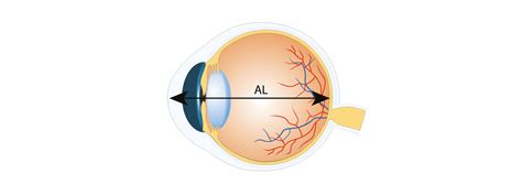 Why Measure Axial Length? | Midwest Eye Associates