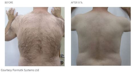 Laser Hair Removal - Dr. Scott's Restorative Health & Aesthetics