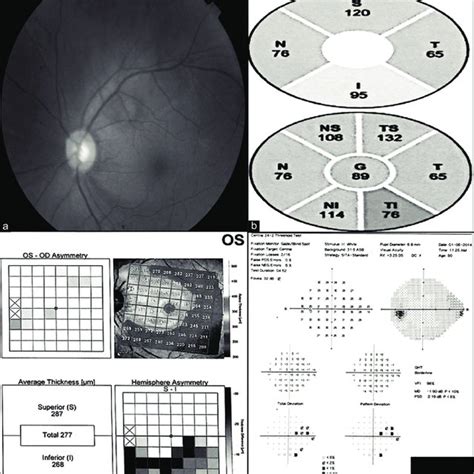 OCT image of the temporal sclera (A). Ciliary muscle (B); Scleral spur ...