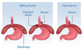 SURGERY FOR HIATUS HERNIA