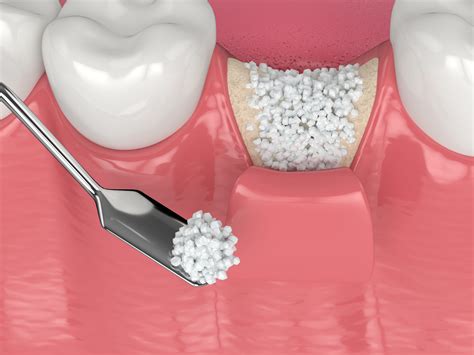 Bone Grafting Surgery | German Dental Clinic Dubai JLT