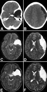 Posts tagged "subdural-hygroma" - Neurosurgery Blog