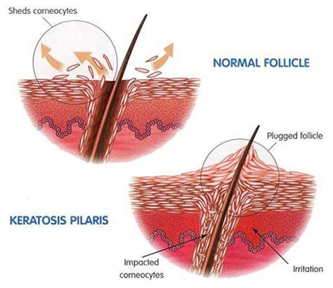 Keratosis Pilaris Legs