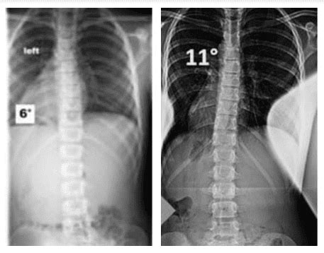 20 Degree Scoliosis