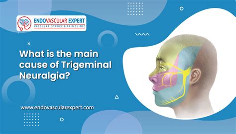 What is the main cause of Trigeminal Neuralgia? - Signs and Symptoms