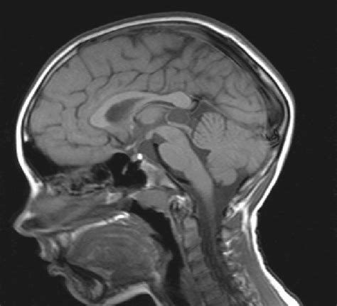 MRI of subject P.B., showing a cyst of the pineal gland | Download ...