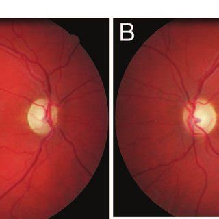 Optic nerve atrophy of the right eye (A) and the left eye (B) in the ...