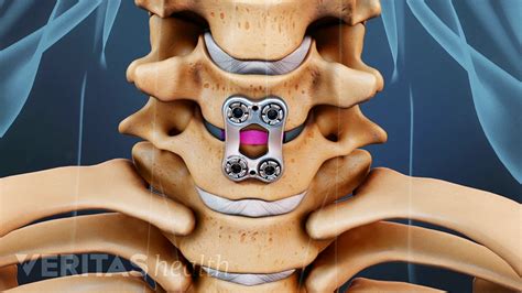 Cervical Discectomy And Fusion