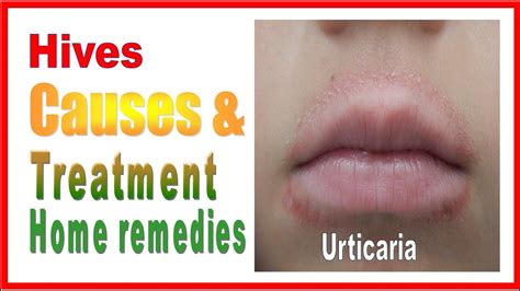 Hives Urticaria treatment home remedies DIYs & cure at home - YouTube