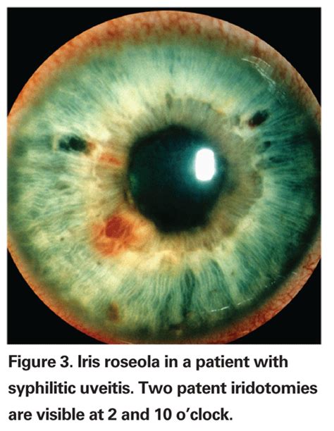 How to Recognize Ocular Syphilis