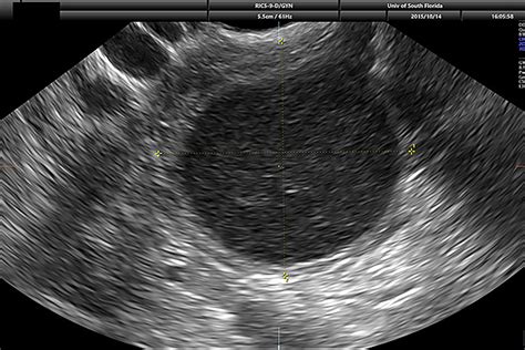 USF Health News 'Watchful waiting' with routine ultrasound safer than removing benign ovarian ...