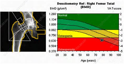 Osteoporosis, X-ray bone densitometry - Stock Image - C039/3259 - Science Photo Library