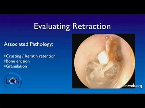 The 18th Otology Course Lecture Tympanic membrane retraction Neil Sperling - YouTube