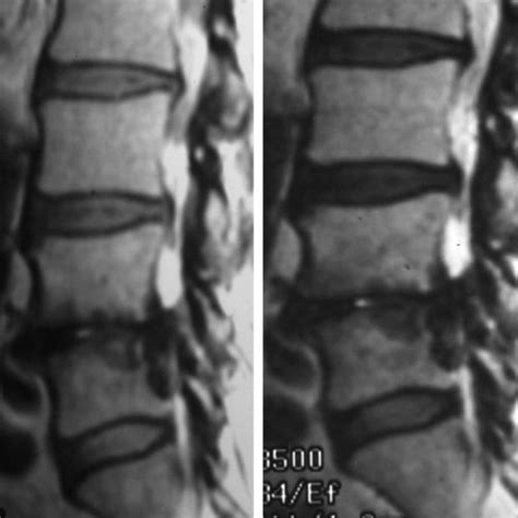 In this dialysis patient with spondyloarthropathy related to ...