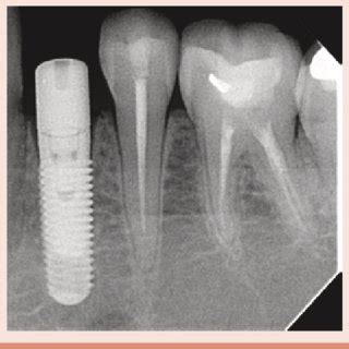 Zimmer Dental Implants