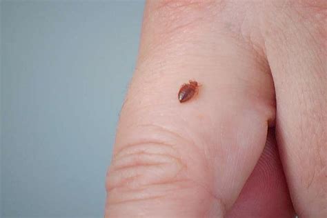 13 Home Remedies For Getting Rid of The Irritating Chigger Bites