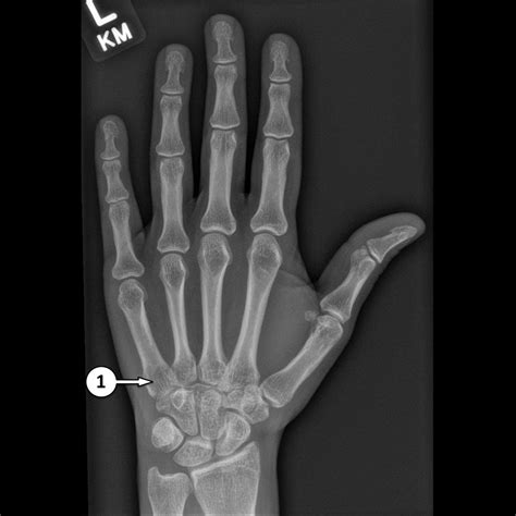 Top 93+ Pictures Normal X-ray Of Hand And Wrist Sharp