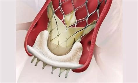 Bioprosthetic valve fracture performed after transcatheter valve-in ...