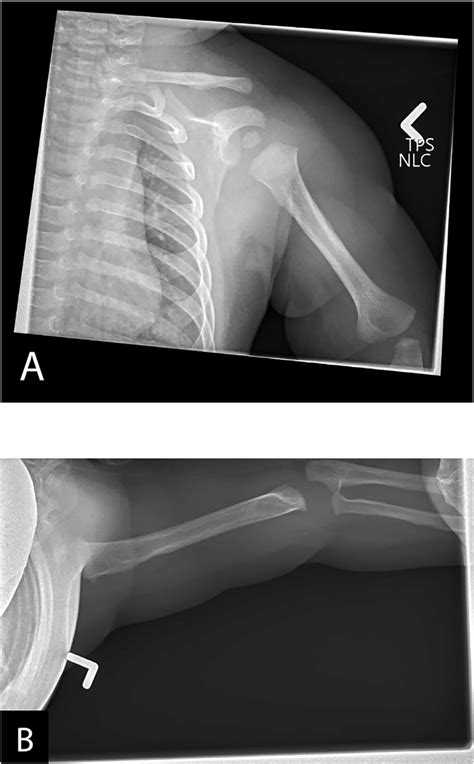 Anteroposterior and axillary shoulder x-rays at 5 months of age. | Download Scientific Diagram