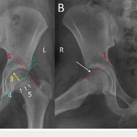 Diagnostic signs of SCFE shown on the AP (A) and FL (B) pelvis view of... | Download Scientific ...