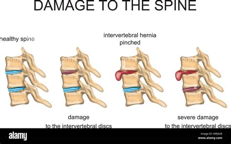 ILLUSTRATION OF A HEALTHY INTERVERTEBRAL DISC, THE DAMAGED INTERVERTEBRAL DISC, HERNIATION Stock ...