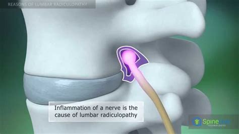 Lumbar Radiculopathy Myotomes