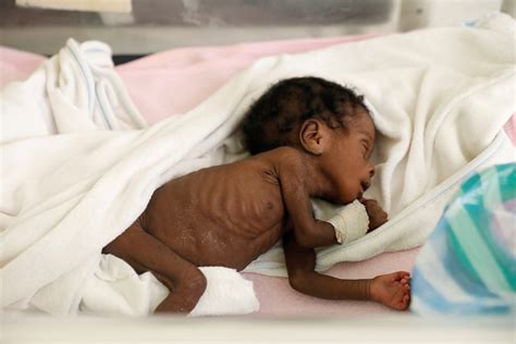 Amid gang wars and food shortages, Haiti hospital struggles to treat malnourished children ...