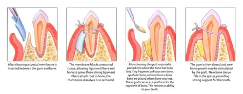 Guided Tissue Regenration in Birmingham, AL - Periodontist in ...