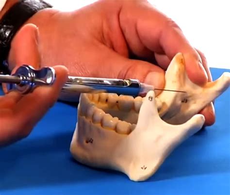 DENTAL ANESTHESIA : Mandibular Anesthesia Injection Techniques