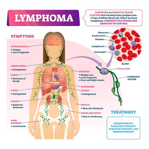 Lymphoma - Hematology & Oncology | Cancer Care Center | Edison | Woodbridge | Union