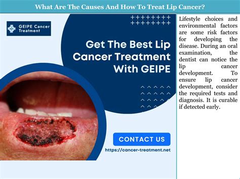 What Are The Causes And How To Treat Lip Cancer by GEIPE Cancer ...