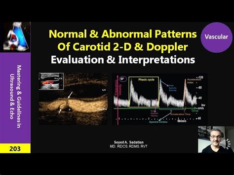 Carotid Doppler Ultrasound