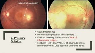 Episcleritis & Scleritis (causes, clinical features, treatment).pptx