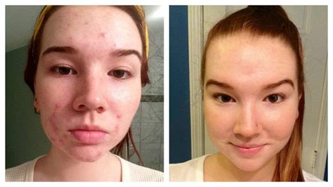 Skin Tag & Acne Patch | An Absolute Review - Cheaperks