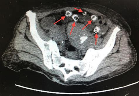 Diverticulitis On Ct Scan