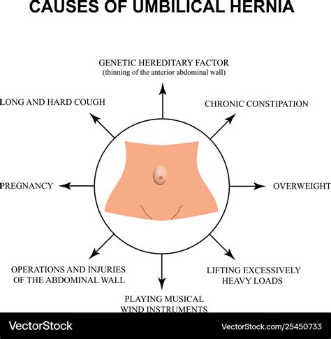 Stomach Hernia Types