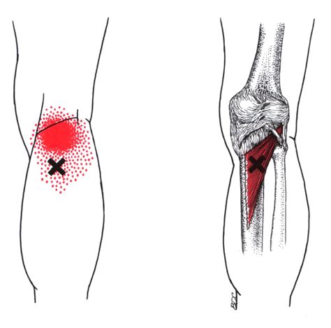 Popliteus | The Trigger Point & Referred Pain Guide