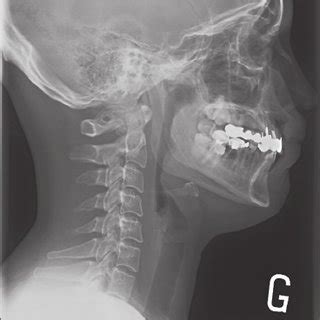 Soft Tissue Neck X Ray