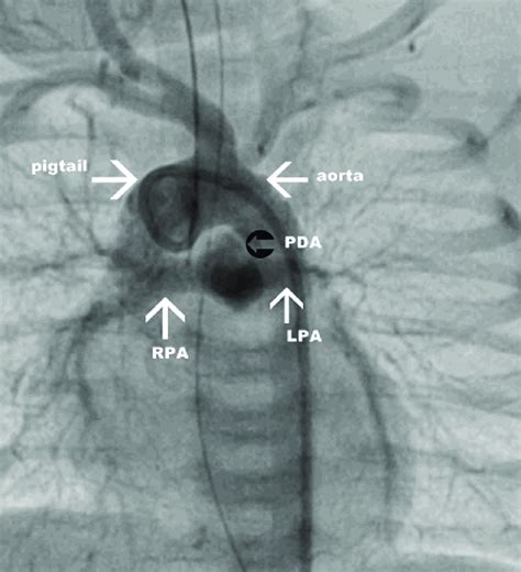 Aortogram done through 4 F pigtail catheter showing patent ductus... | Download Scientific Diagram