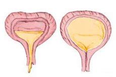 Bladder atony: causes, symptoms, treatment with drugs