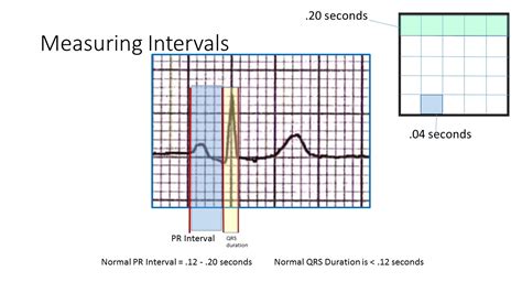 Measuring Intervals - Basic Illustration | ECG Guru - Instructor Resources