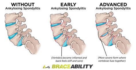 Spondylosis – Spondylolysis – Spondylolisthesis - Motus Physical Therapy