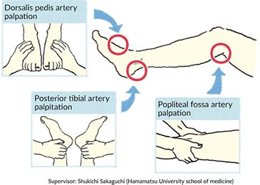 What tests are carried out to diagnose PAD? | Otsuka Pharmaceutical Co., Ltd.