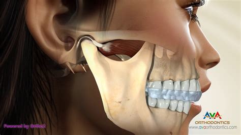 TMJ Occlusal Splint - YouTube