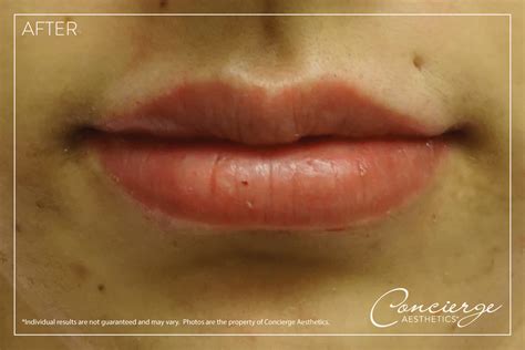 B and A - Juvederm Ultra Plus - Lips (23 yo) | Concierge Aesthetics