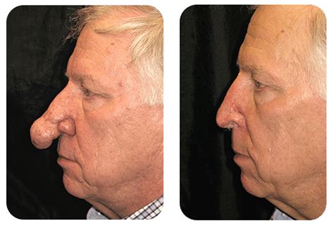 Rhinophyma Treatment & Removal Austin, Texas | CTD