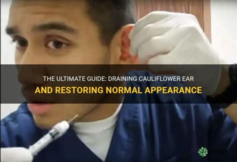 The Ultimate Guide: Draining Cauliflower Ear And Restoring Normal Appearance | ShunCy